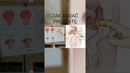 Jak Lekarz Bada Prostatę? Wszystko o Przebiegu Badania.