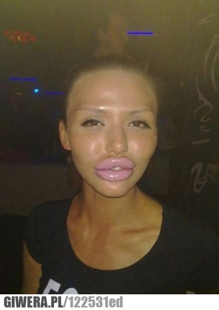 Laska,usta,oszpecenie,botox