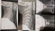For a year I have been in hospital paralyzed with my whole body, I couldn`t do anything.