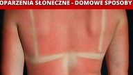 Naturalne Domowe Sposoby na Oparzenia Słoneczne