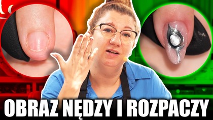 OBRAZ NĘDZY I ROZPACZY - RATUJĘ PIERWSZEGO PAZNOKCIA