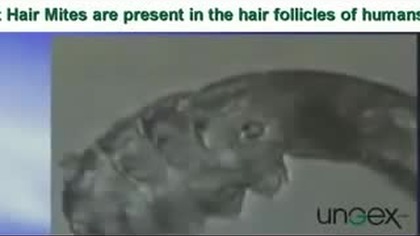 Demodex folliculorum (Nużeniec ludzki) 