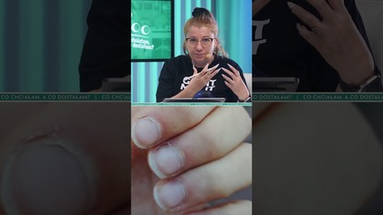 Masz takie skórki? UWAŻAJ!