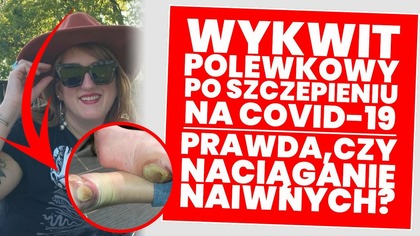 Wykwit polewkowy po szczepieniu na Covid-19? Prawda, czy naciąganie naiwnych?