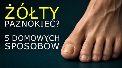 Grzybica paznokci  5 domowych sposobów (i błąd, przez który wraca)