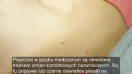Usunęła pieprzyki i przebarwienia na skórze tą prostą metodą w domu