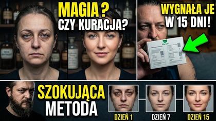 2507.  Ciekawa Historia Znajomej Alergie Wypadające Włosy Cienie Po Oczami Magicznie Znikły