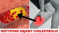 Wysoki CHOLESTEROL: Oznaki Niebezpiecznie WYSOKIEGO poziomu cholesterolu LDL