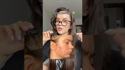 MAM PASOŻYTY?! Macie pytania co do tego tematu?!#trądzik #pasożyty#ceratrądzikowa #wynikibadań