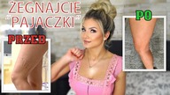 Skleroterapia piankowa - zabieg usuwania pajączków | Efekty, ból, cena