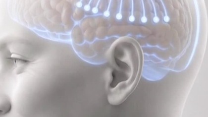 Pierwszy na świecie komercyjny implant mózgowy zatwierdzony.