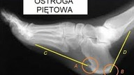 WYZDROWIEJESZ 60 # 192 OSTROGA PIĘTOWA