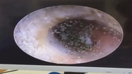 LiveLeak - Vietnamese doctor finds dozens of mushrooms growing in womans ears