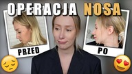 WSZYSTKO O MOJEJ OPERACJI NOSA 1. 5 ROKU PÓŹNIEJ