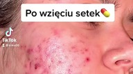 nie dla wrażliwych #trądzik