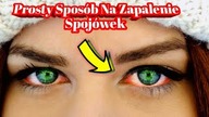 1901.  Prosty Spos&oacute;b Na Zapalenie Spoj&oacute;wek