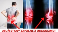 USUŃ te PRODUKTY ze SWOJEJ DIETY aby pozbyć się STANÓW ZAPALNYCH z organizmu