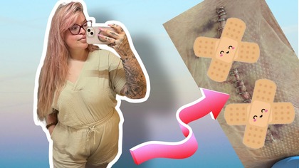 TYDZIEN PO OPERACJI-JAK SIE GOI MOJA RANA?