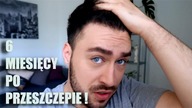 FRYZJER PRZESZCZEPIŁ SOBIE WŁOSY ! 6 miesięcy po zabiegu !  CiaRo UsaGo :D