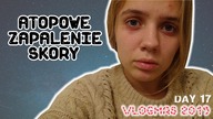 ATOPOWE ZAPALENIE SKÓRY - czy trzeba się wstydzić? VLOGMAS #17 2019
