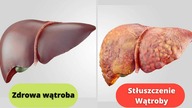 STŁUSZCZENIE WĄTROBY - jak naturalnie poradzić sobie z tym problemem? Właśnie tak