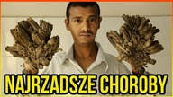 10 NAJRZADSZYCH I NAJDZIWNIEJSZYCH CHORÓB