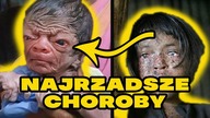 10 NAJRZADSZYCH I NAJDZIWNIEJSZYCH CHORÓB