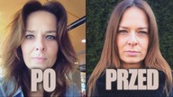 Czy igła i laser usuną 'worki' pod oczami? [Piękno Boli]