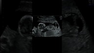USG Prenatalne
