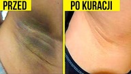 Jak Rozjaśniać Ciemną Skórę Na Łokciach Pod Pachami i Kolanach Szybko w Domu