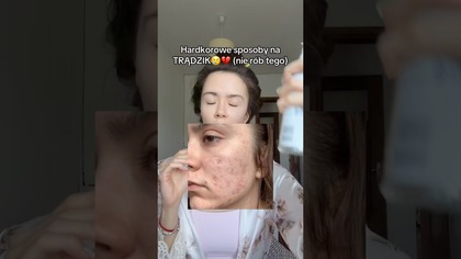 HARDKOROWE SPOSOBY NA TRĄDZIK  #trądzik #acne