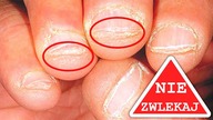Przestań Obgryzać Paznokcie Raz Na Zawsze!
