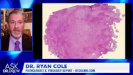 Obrazy i slajdy z mikroskopu - Długie Skrzepy krwi z mRNA, m&oacute;wi patolog dr Ryan Cole z dr Kel