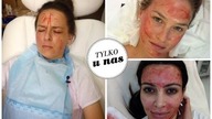 Wampirzy lifting, czy ulubiony zabieg Kim Kardashian działa?  [Piękno Boli]