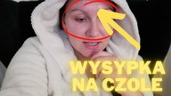 WYSYPKA NA CZOLE PO ZABIEGU Z KWASAMI
