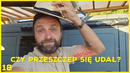 WSZYSCY CHCĄ TO WIEDZIEĆ - efekt przeszczepu - PÓŁ ROKU PO ZABIEGU