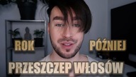 ROK PO PRZESZCZEPIE WŁOSÓW !!!    CiaRo UsaGo :D