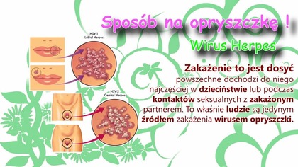 Sposób na opryszczkę.