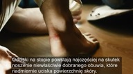 Pozbądź się odcisków na palcach i nogach - Najlepsze sposoby