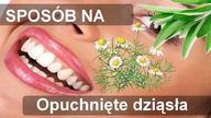 Sposoby na opuchliznę dziąsła