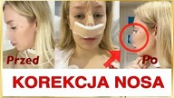 WSZYSTKO O MOJEJ KOREKCJI / CENA I EFEKTY