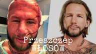 PRZESZCZEP WŁOSÓW - Moja historia (Dr.  Tomasz Mierzwiński)