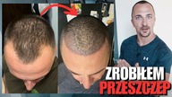 Zrobiłem PRZESZCZEP włosów w Turcji