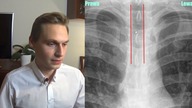 Student Medycyny Ogląda Zdjęcie Klatki Piersiowej (RTG) #003