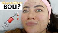 ZEBY BYC PIEKNA TRZEBA CIERPIEC?| Akupunktura kosmetyczna na zywo