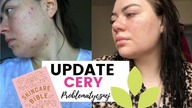 CO POMAGA MOJEJ CERZE? | Update skóry problematycznej
