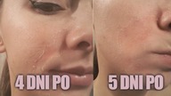 Peeling Jessnera - idealny na trądzik, przebarwienia i drobne zmarszczki. Czy warto? [Piękno Boli]