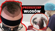 Zrobiłem PRZESZCZEP WŁOSÓW w Turcji - to działa!
