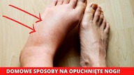 OPUCHNIĘTE Nogi I Stopy  Domowe Sposoby  Skuteczne I Sprawdzone!