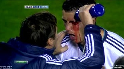 Cristiano Ronaldo (Real) krwawy uraz w meczu z Levante